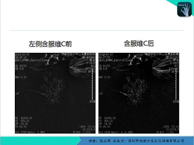 【PPT】腮腺MRI检查对干燥综合征SS的诊断价值