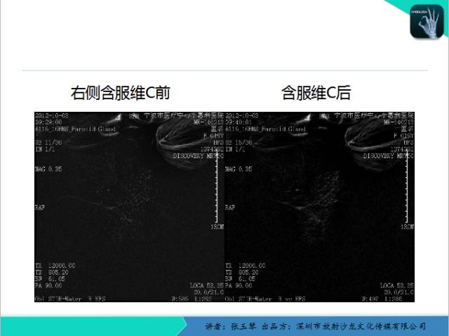 【PPT】腮腺MRI检查对干燥综合征SS的诊断价值