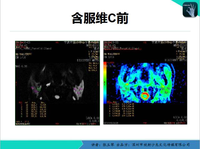 【PPT】腮腺MRI检查对干燥综合征SS的诊断价值