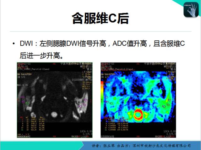 【PPT】腮腺MRI检查对干燥综合征SS的诊断价值
