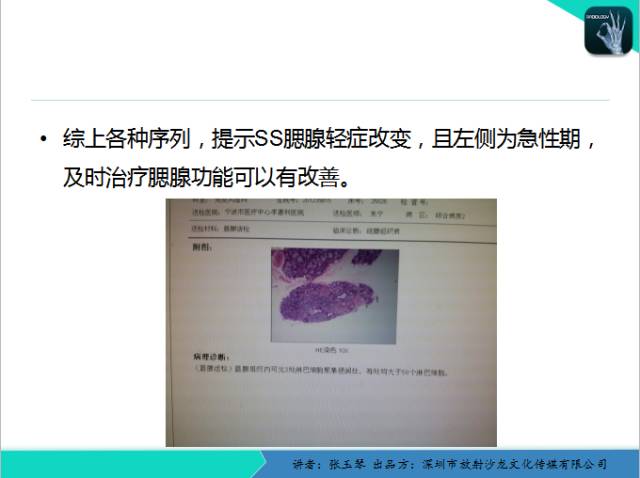 【PPT】腮腺MRI检查对干燥综合征SS的诊断价值