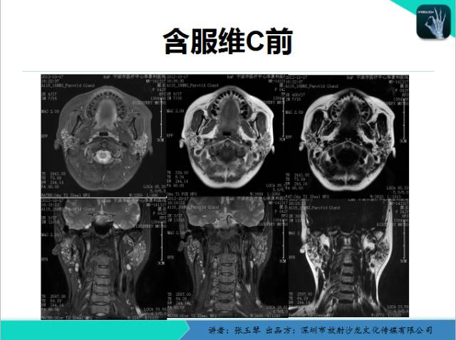 【PPT】腮腺MRI检查对干燥综合征SS的诊断价值