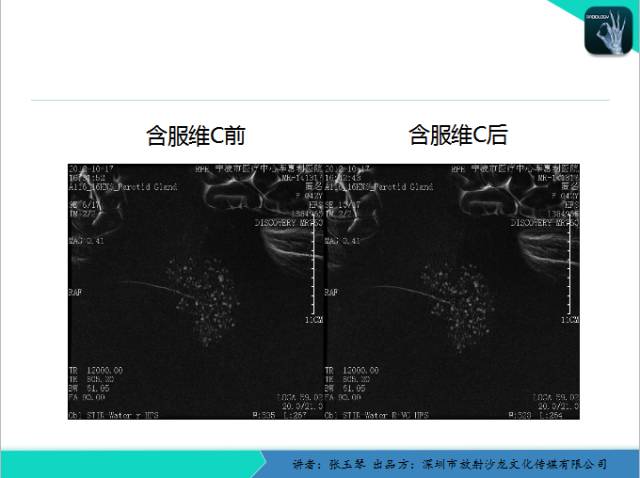 【PPT】腮腺MRI检查对干燥综合征SS的诊断价值