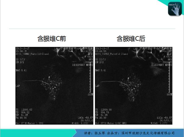 【PPT】腮腺MRI检查对干燥综合征SS的诊断价值