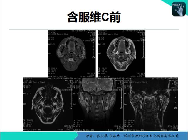 【PPT】腮腺MRI检查对干燥综合征SS的诊断价值