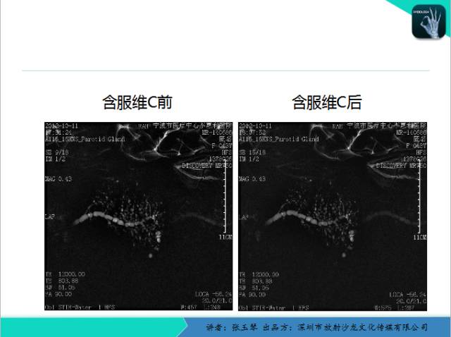 【PPT】腮腺MRI检查对干燥综合征SS的诊断价值