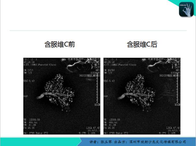 【PPT】腮腺MRI检查对干燥综合征SS的诊断价值