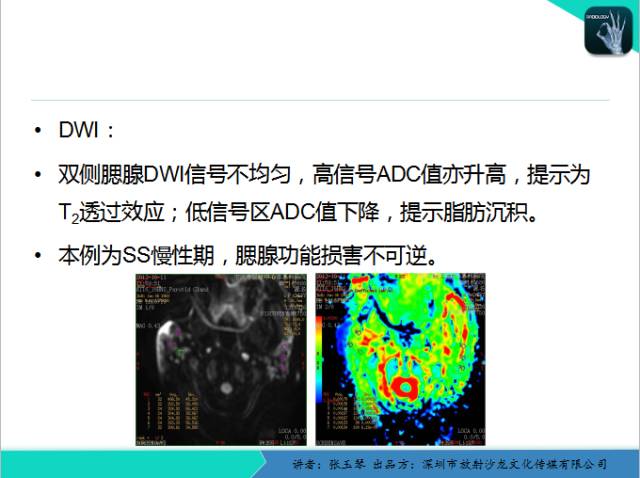 【PPT】腮腺MRI检查对干燥综合征SS的诊断价值