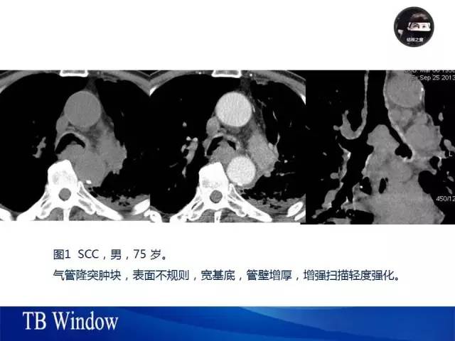 【PPT】气管支气管肿瘤文献回顾