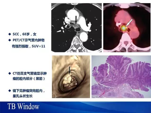 【PPT】气管支气管肿瘤文献回顾