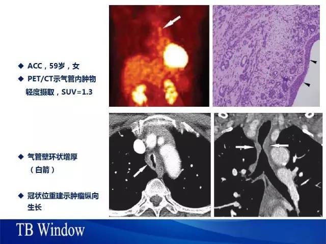 【PPT】气管支气管肿瘤文献回顾