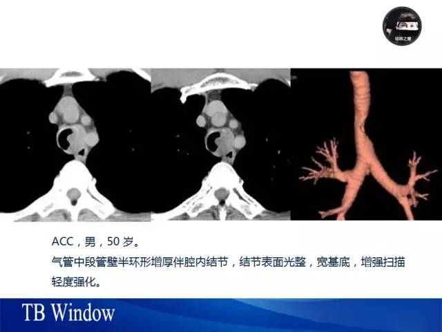 【PPT】气管支气管肿瘤文献回顾