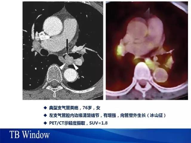 【PPT】气管支气管肿瘤文献回顾