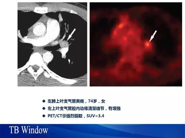 【PPT】气管支气管肿瘤文献回顾