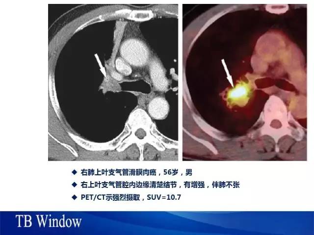 【PPT】气管支气管肿瘤文献回顾