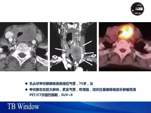【PPT】气管支气管肿瘤文献回顾