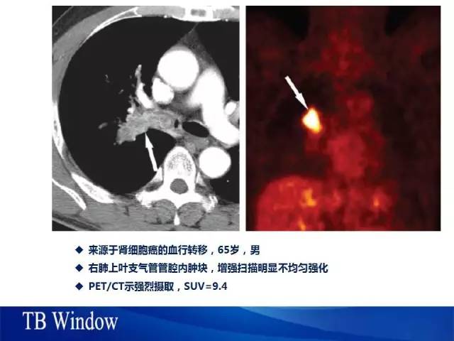 【PPT】气管支气管肿瘤文献回顾