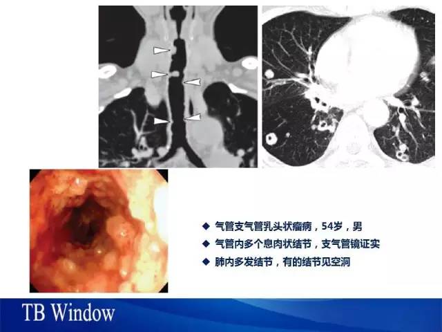 【PPT】气管支气管肿瘤文献回顾