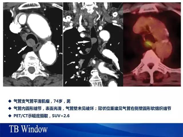 【PPT】气管支气管肿瘤文献回顾