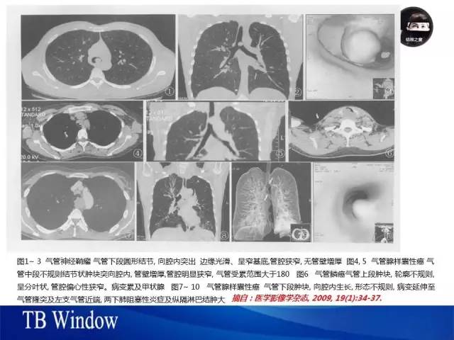 【PPT】气管支气管肿瘤文献回顾