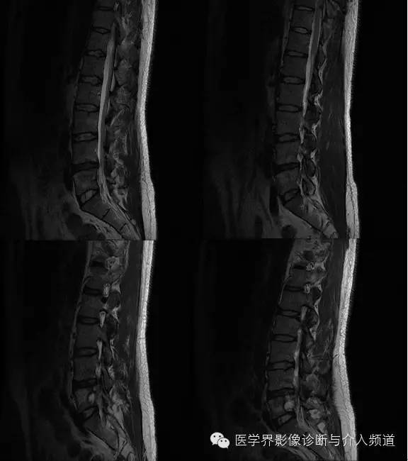 【病例】腰椎结核MR影像表现