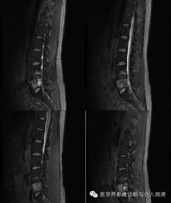 【病例】腰椎结核MR影像表现 【病例】腰椎结核MR影像表现