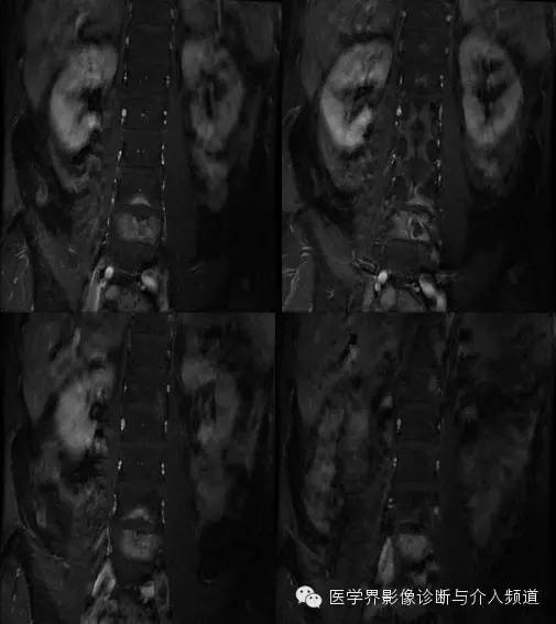 【病例】腰椎结核MR影像表现 【病例】腰椎结核MR影像表现