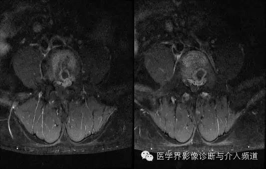 【病例】腰椎结核MR影像表现 【病例】腰椎结核MR影像表现