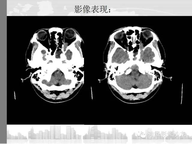 【病例】颅底炎性假瘤1例CT及MR影像表现