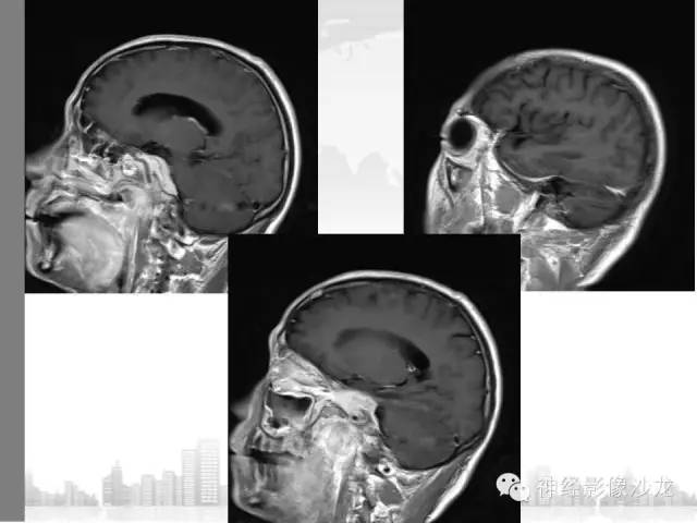 【病例】颅底炎性假瘤1例CT及MR影像表现