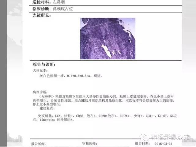 【病例】颅底炎性假瘤1例CT及MR影像表现