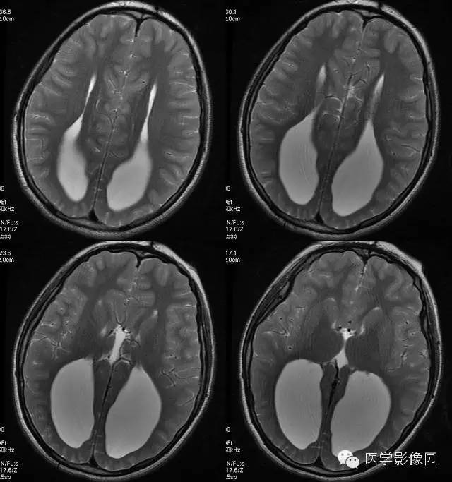 【病例】胼胝体缺如 【病例】胼胝体缺如