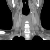 【病例】甲状腺乳头状癌1例CT影像表现 【病例】甲状腺乳头状癌1例CT影像表现
