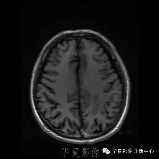 【病例】这个脑转移瘤你会误诊吗？