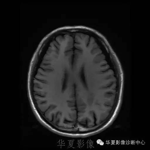 【病例】这个脑转移瘤你会误诊吗？