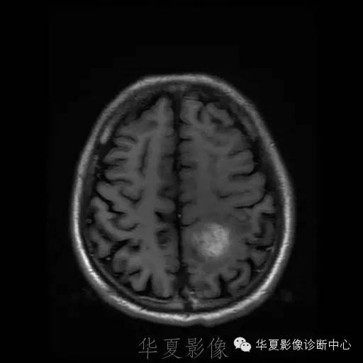 【病例】这个脑转移瘤你会误诊吗？