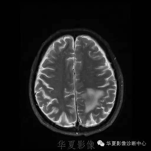 【病例】这个脑转移瘤你会误诊吗？