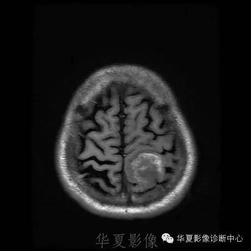 【病例】这个脑转移瘤你会误诊吗？