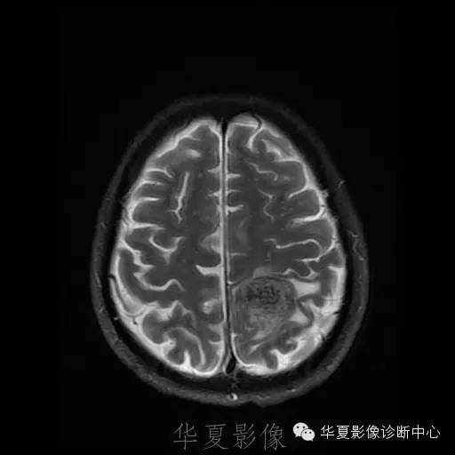 【病例】这个脑转移瘤你会误诊吗？