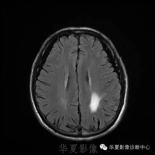 【病例】这个脑转移瘤你会误诊吗？