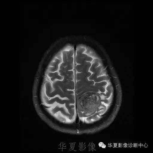 【病例】这个脑转移瘤你会误诊吗？