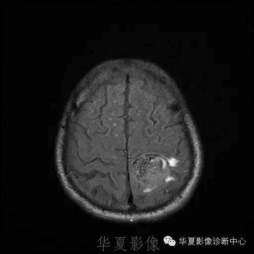 【病例】这个脑转移瘤你会误诊吗？