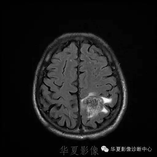 【病例】这个脑转移瘤你会误诊吗？
