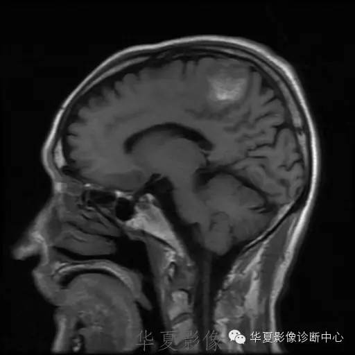 【病例】这个脑转移瘤你会误诊吗？
