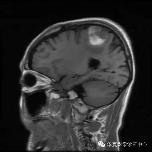 【病例】这个脑转移瘤你会误诊吗？