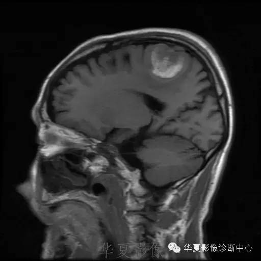 【病例】这个脑转移瘤你会误诊吗？