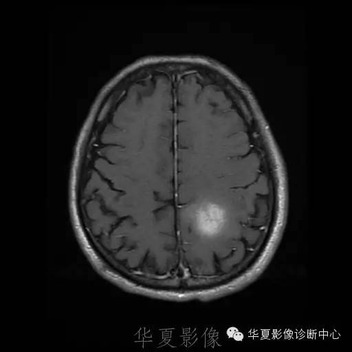 【病例】这个脑转移瘤你会误诊吗？