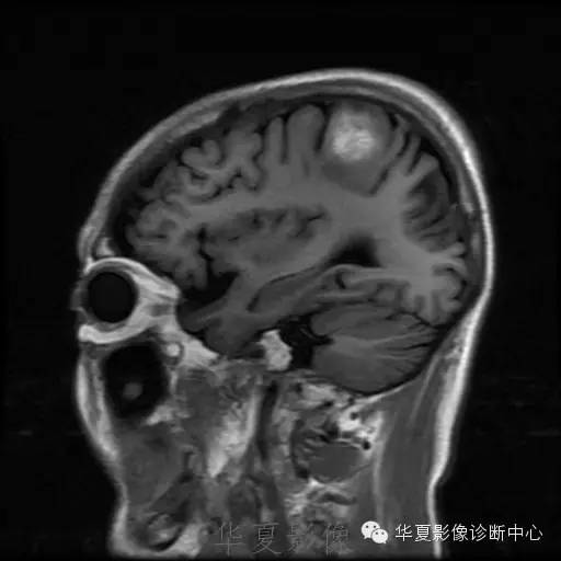【病例】这个脑转移瘤你会误诊吗？