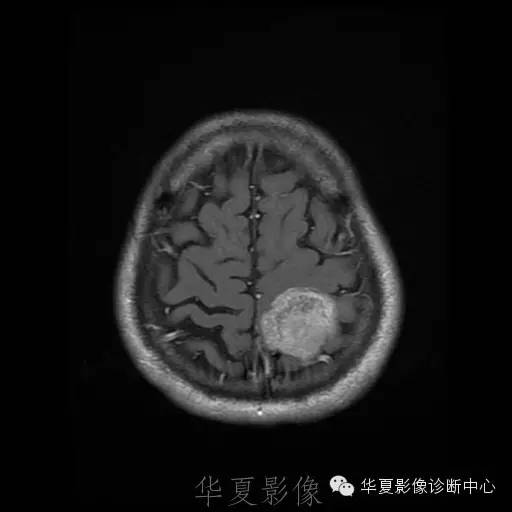 【病例】这个脑转移瘤你会误诊吗？