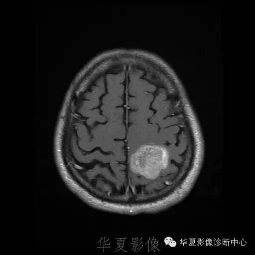 【病例】这个脑转移瘤你会误诊吗？
